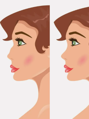 Rhinoplastie (chirurgie esthétique sur le nez)