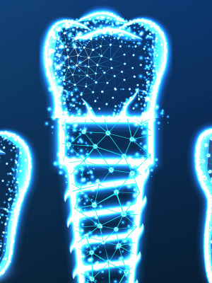  Dental Implants