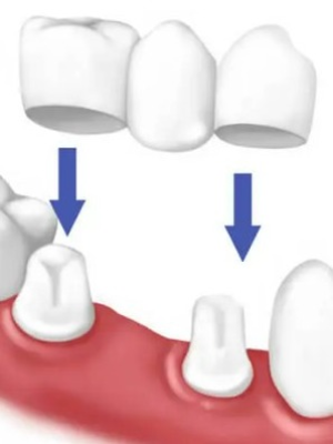 Dental Crown